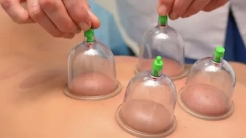 cupping therapy practical steps