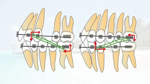 Deep bite correction. Correction of bilateral posterior open bite. Part of full orthodontics dentistry course