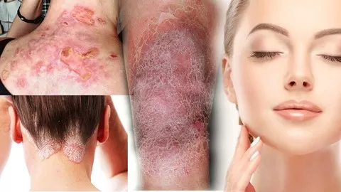 Cure Most Of Skin Diseases Naturally & Permanently