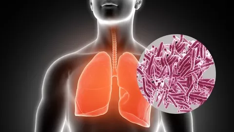 Learn about Tuberculosis - Its symptoms