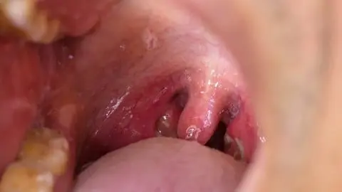 Swollen uvula